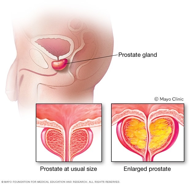Próstata agrandada en comparación con una de tamaño normal