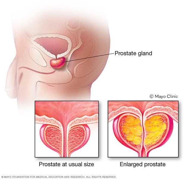 prostata adenomatosa bilobata