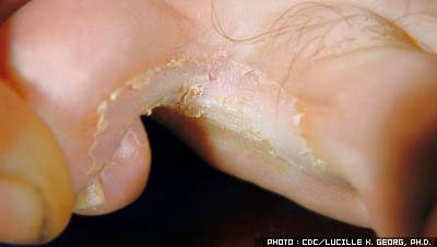 Athlete s foot toes Mayo Clinic