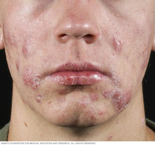Acne - Symptoms and causes - Mayo Clinic