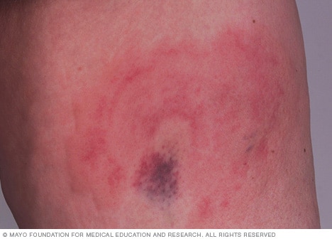 Urticarial vasculitis - Mayo Clinic