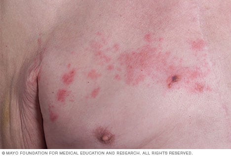 Image of shingles rash 
