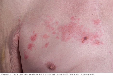 herpes en la piel causas y consecuencias