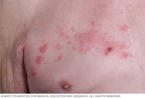 Shingles rash 