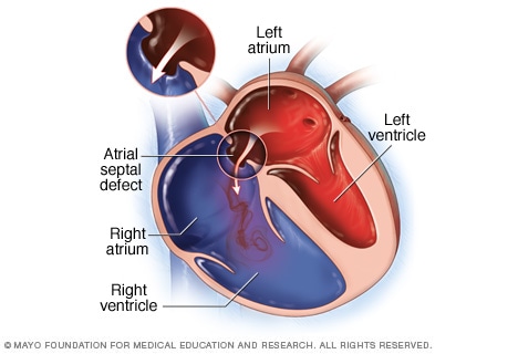 Pathophysiology Of Atrial Septal Defect In Flow Chart