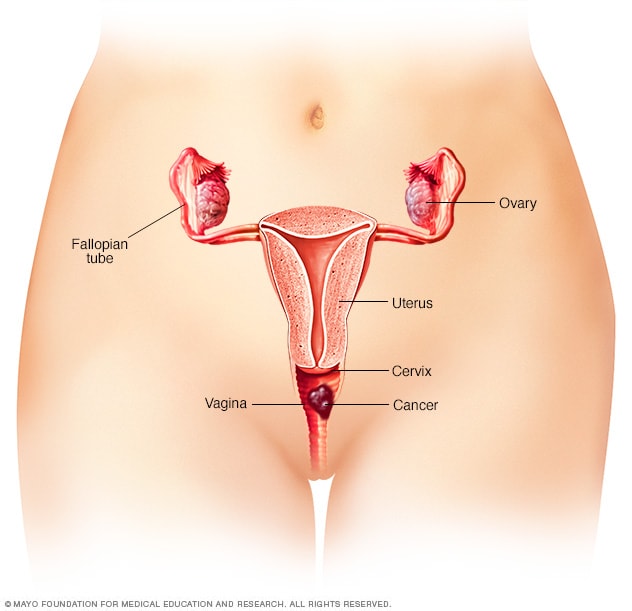 cancer genital feminin symptome