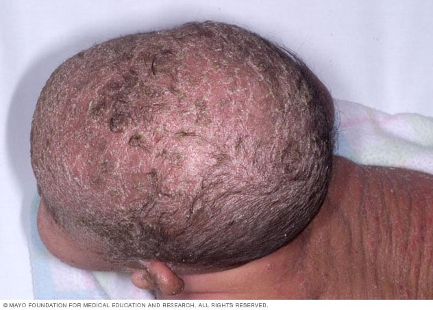 Cradle cap on Black skin