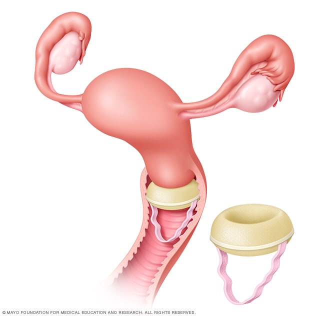 Contraceptive sponge placement - Mayo Clinic