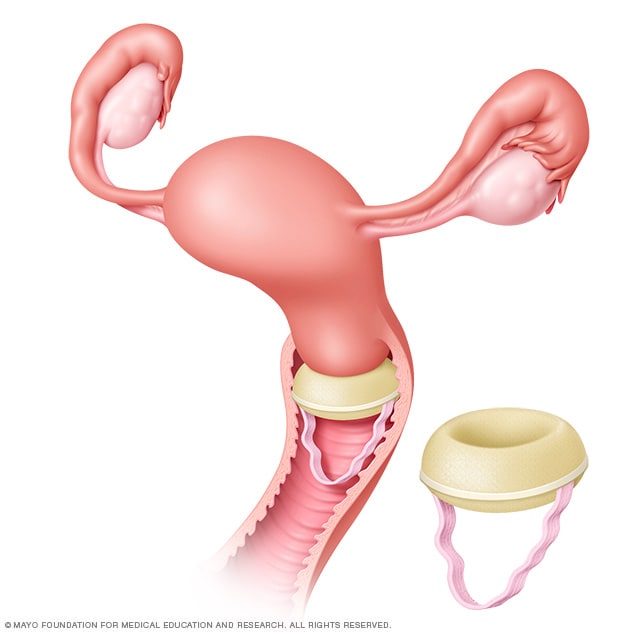 Contraceptive sponge in place over the cervix