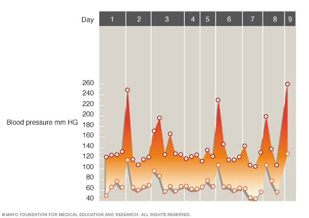 Gráfico que muestra fluctuaciones de la presión arterial provocadas por feocromocitoma