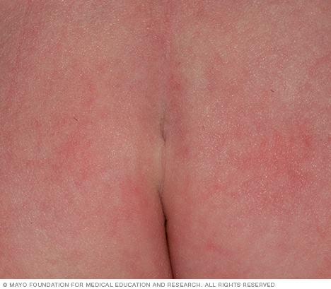 臀部间皱褶上方的皮肤凹陷通常无害。