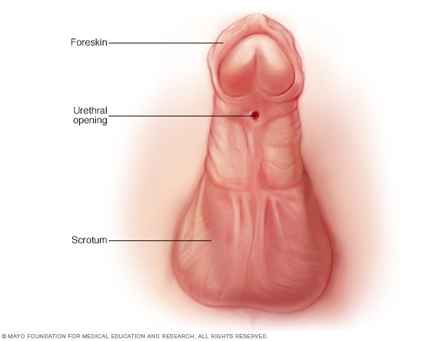 Hypospadiasis tünetei és kezelése - HáziPatika