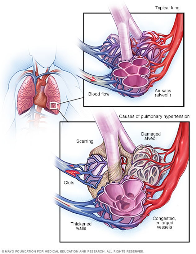 Blood flow in lungs, and normal and blocked pulmonary arteries