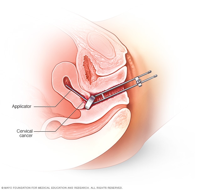 Ilustración de la braquiterapia intracavitaria