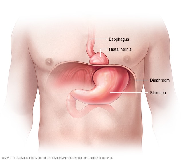 Hiatal Hernia Size Chart