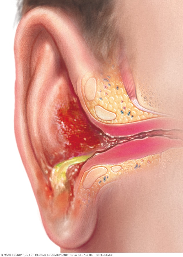 Outer ear infection 