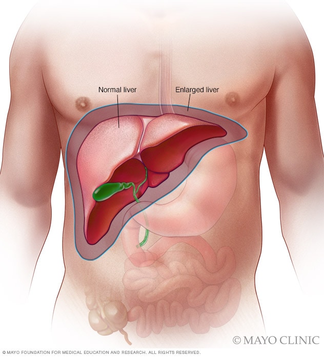 Enlarged Liver Symptoms And Causes Mayo Clinic