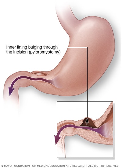 Surgery to treat pyloric stenosis