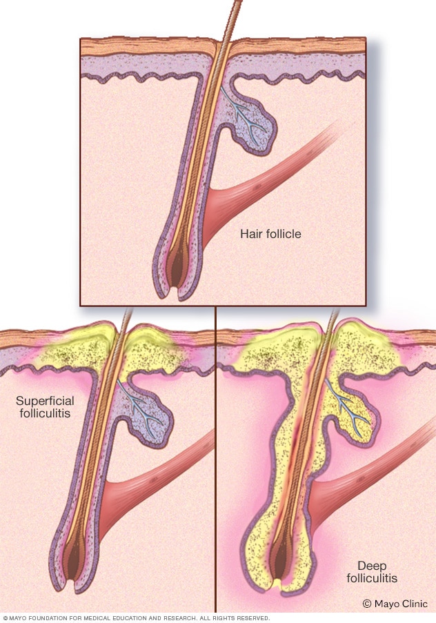 Blocked Hair Follicles Causes Pictures Treatment and Prevention