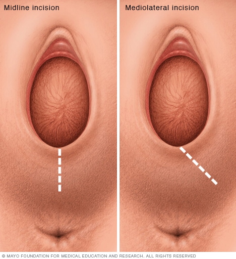 Vaginal Tears After Sex