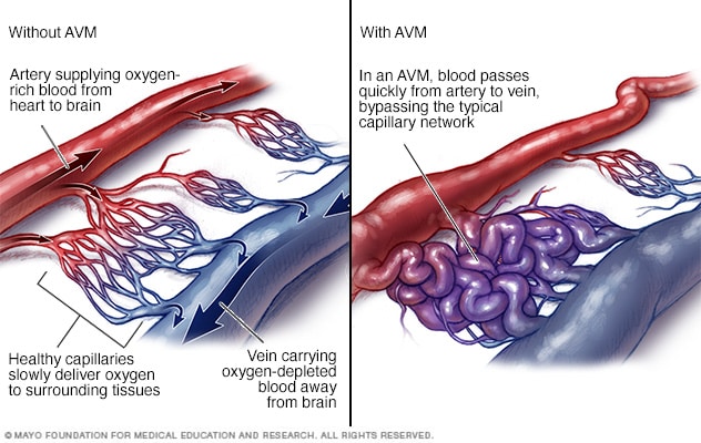 Flujo sanguíneo en la malformación arteriovenosa