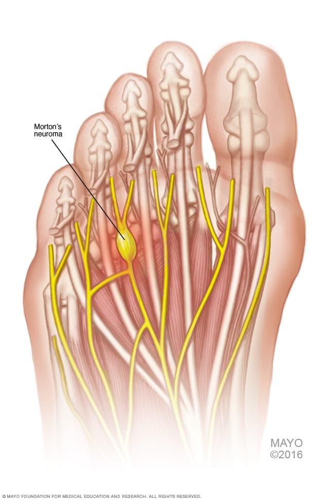 Image result for Mortons neuroma