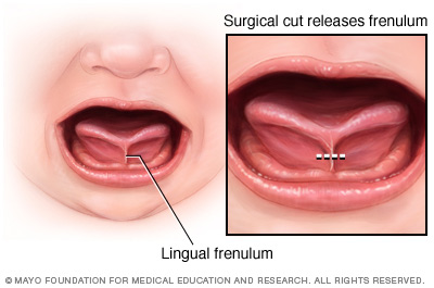 Breve op heilung frenulum Prepuce Pain