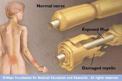 Ilustración de un nervio y una vaina de mielina dañada 