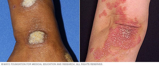 How Does Smoking Affect Psoriasis?