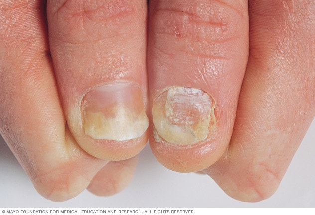 Nail Clinic: Understanding Psoriasis | Nailpro