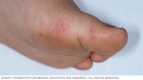 Erupción en el pie provocada por la enfermedad de manos, pies y boca