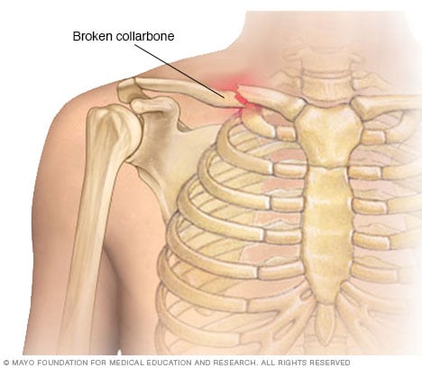 clavicle bone fracture