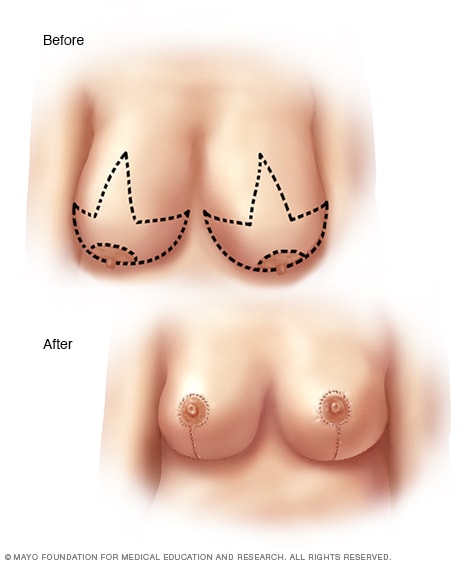 Incisões feitas para cirurgia de redução de mama