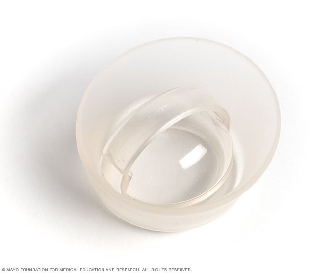 Photo of a cervical cap 
