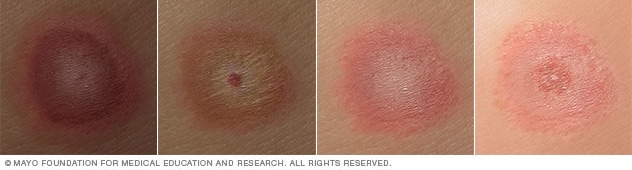 Lyme disease rash on different skin colors.