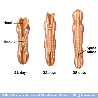 Ilustración de una espina bífida 