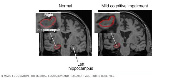 脑萎缩的 MRI 磁共振成像图像