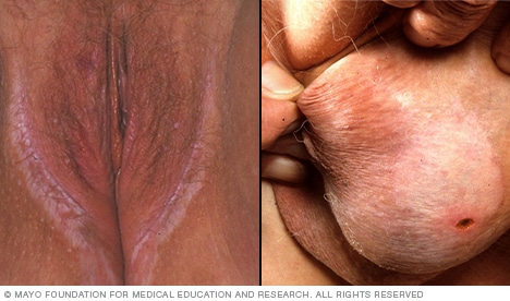 Lichen sclerosus in genital area