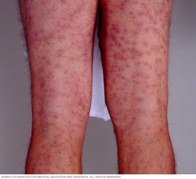 Swimmer S Itch Symptoms And Causes Mayo Clinic