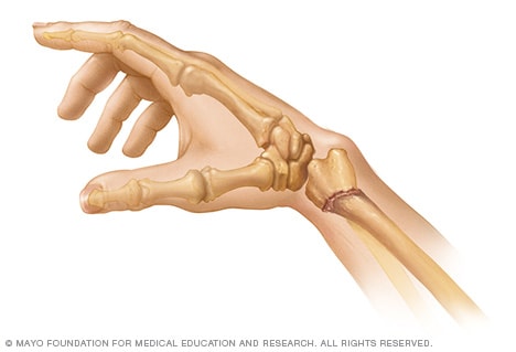 Colles' fracture of the wrist, illustration - Stock Image - C046/2994 -  Science Photo Library