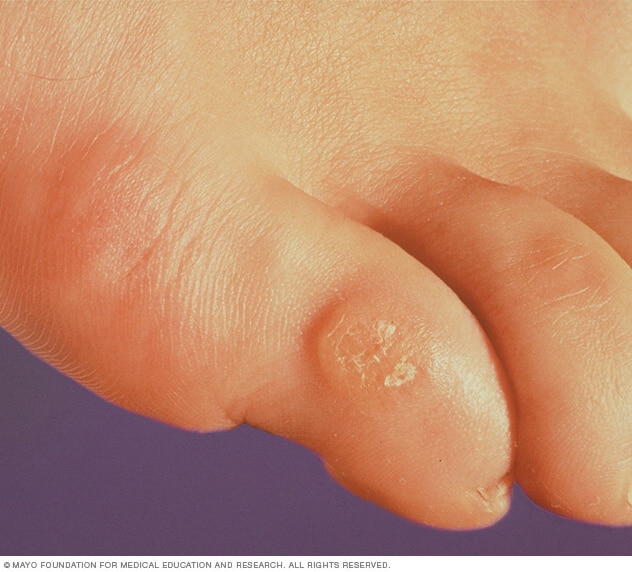 Corns and calluses - Symptoms and 