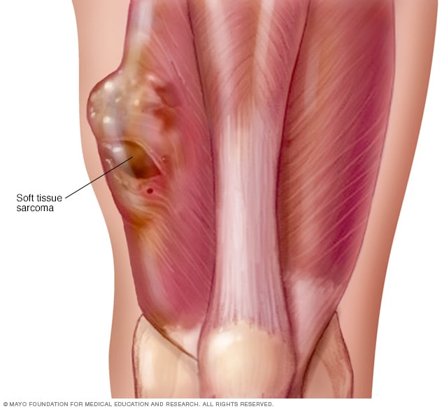 Sarcoma cancer warning signs