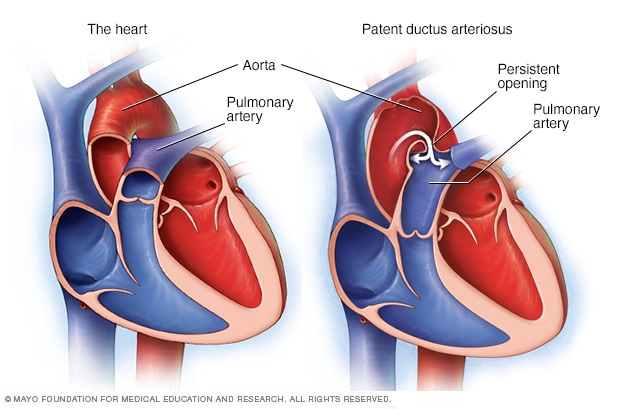 Conducto arterioso persistente