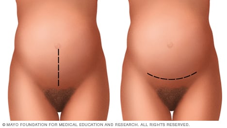 Incisiones abdominales realizadas en cesáreas