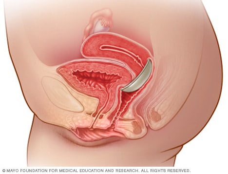 Illustration showing diaphragm placement 
