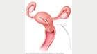 Mirena IUD in place in the uterus