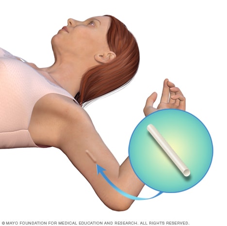 Illustration showing insertion of contraceptive implant