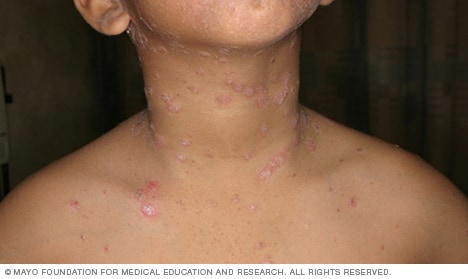 can psoriasis be cured in early stages vörös folt a szem sarkában a bőrön