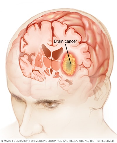 Illustration showing brain cancer 