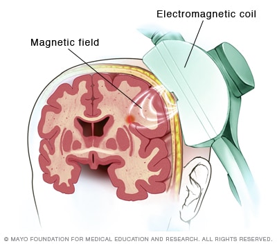 Transcranial magnetic stimulation Mayo